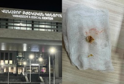 Кусочек грецкого ореха застрял в бронхе: в Ванадзоре спасли 61-летнего мужчину
